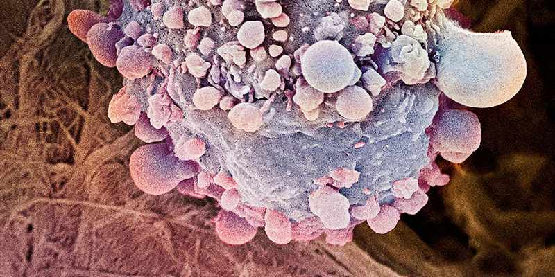 первые признаки рака поджелужочной железы