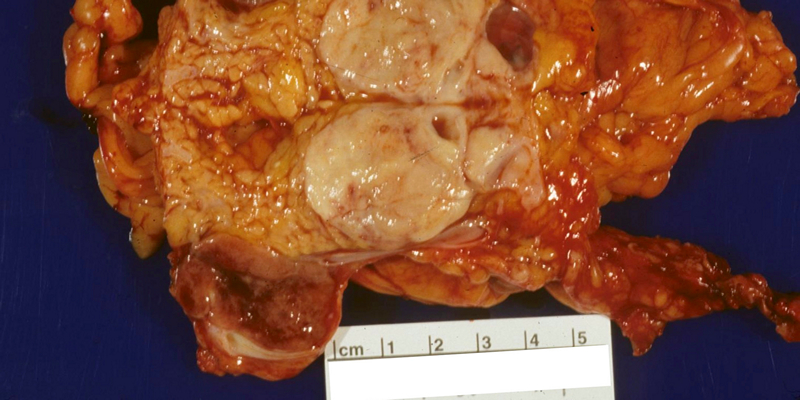 Рак поджелудочная железа нейроэндокринный thumbnail