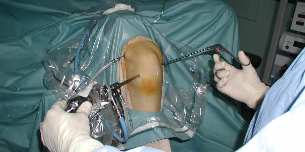 ortopedsko liječenje artritis artroza koje tablete protiv bolova u zglobovima koljena