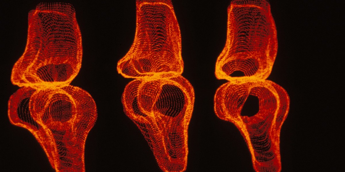 ortopedsko liječenje artritis artroza poslastica bol u zglobovima