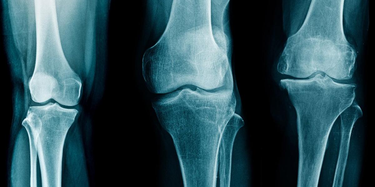 Artritis – osteoartritis