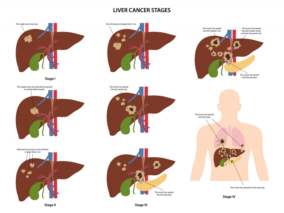Cancer hepatic (de ficat) - Tot ce trebuie să ştii | Cancer