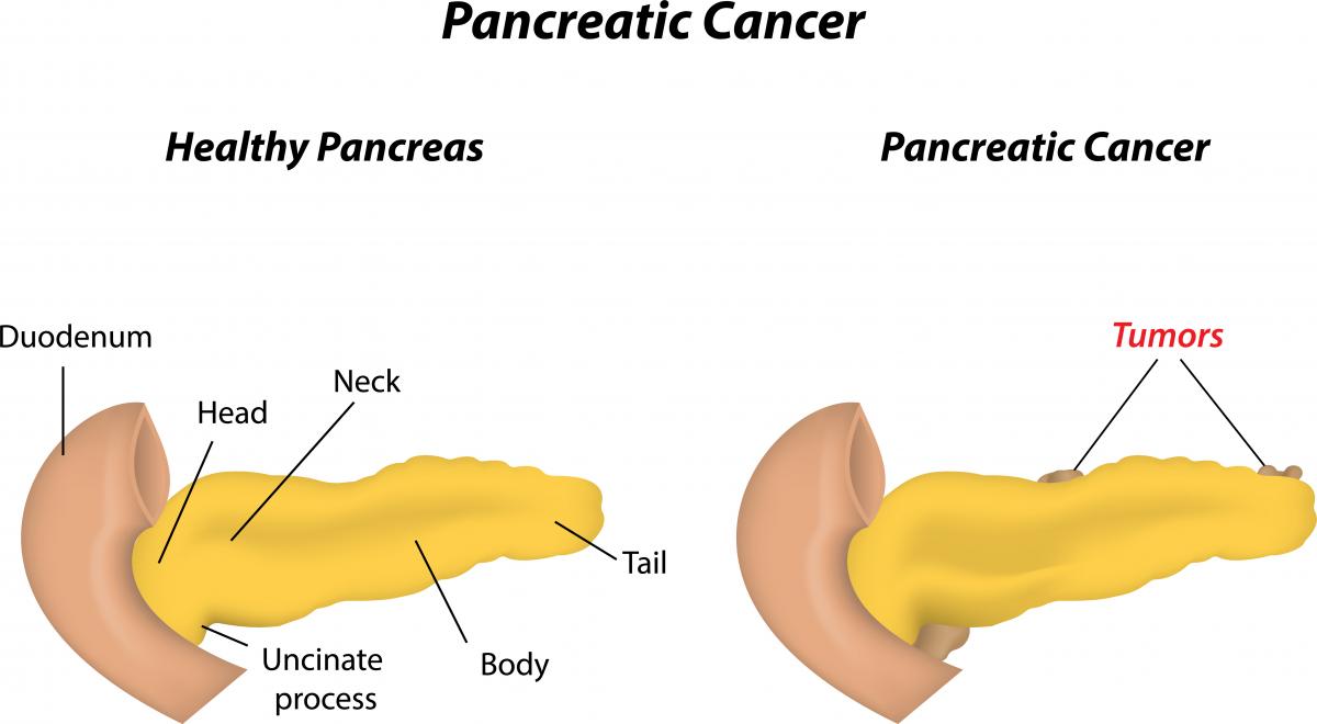 Симптомы хронического панкреатита поджелудочной железы