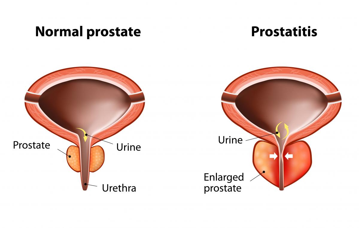 a prosztatitis kezelésére szolgáló árak enuresis és prostatitis