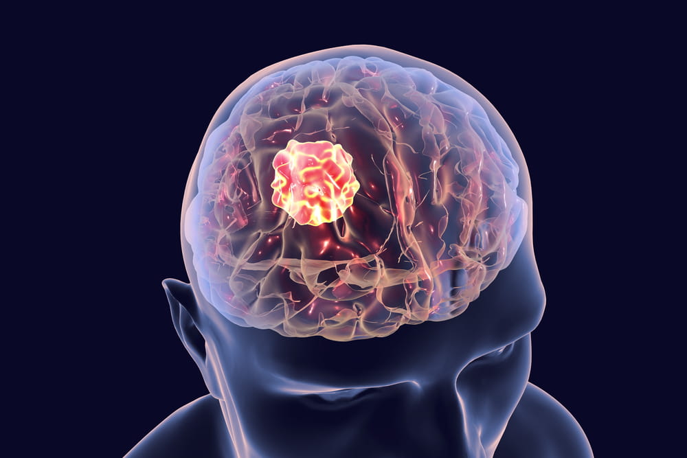 Опухоли головного мозга - причины, симптомы, диагностика и лечение