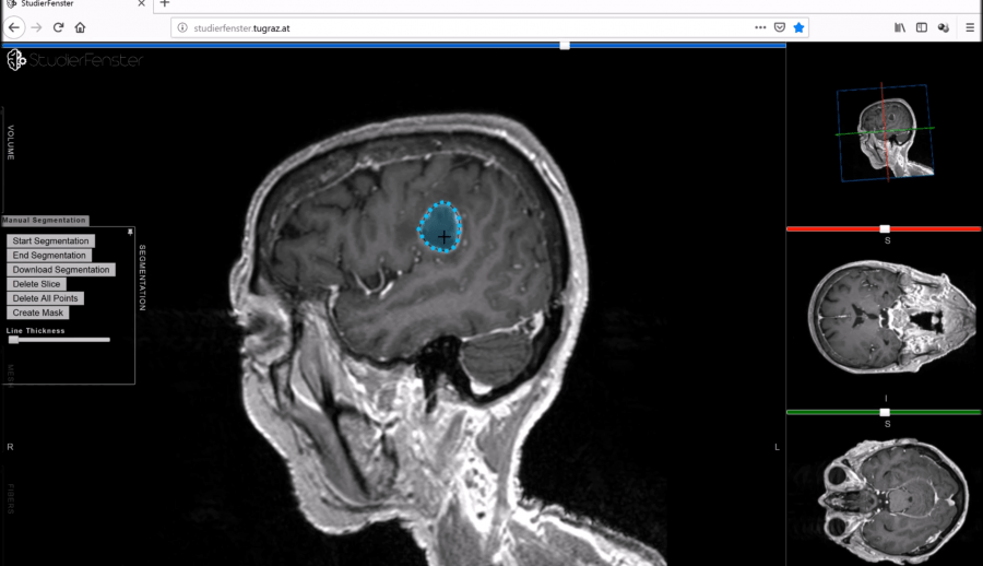 Снимок опухоли мозга